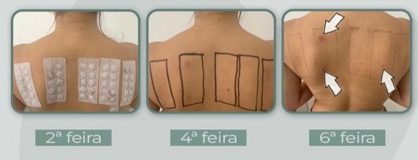 Teste cutâneo alérgico de contato